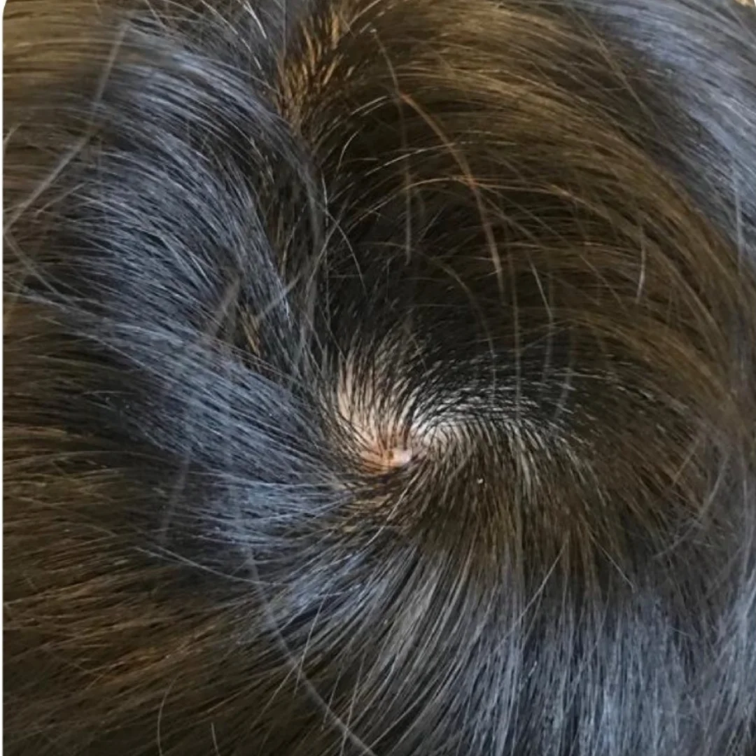 alopecia areata hair loss after