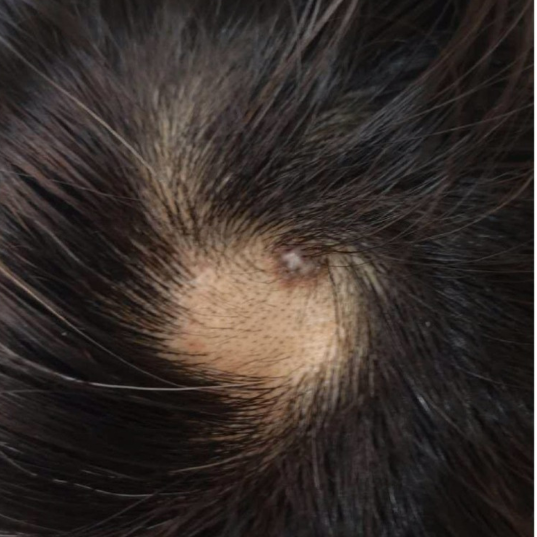 alopecia areata hair loss before