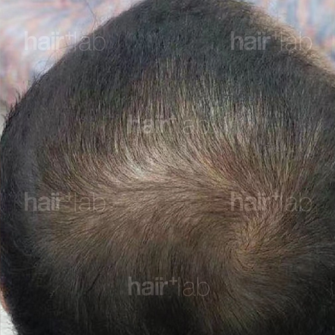 hormonal imbalance hair loss after