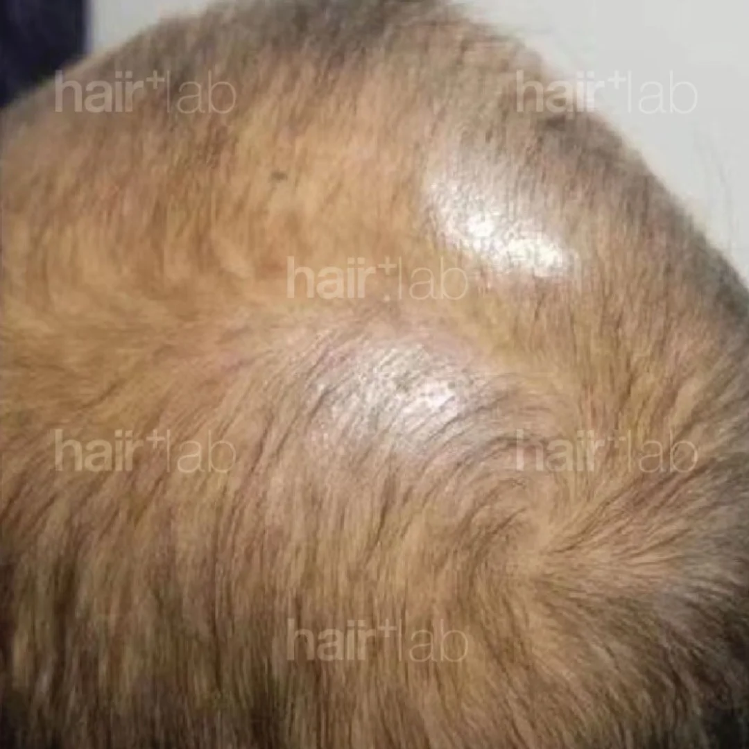 hormonal imbalance hair loss before