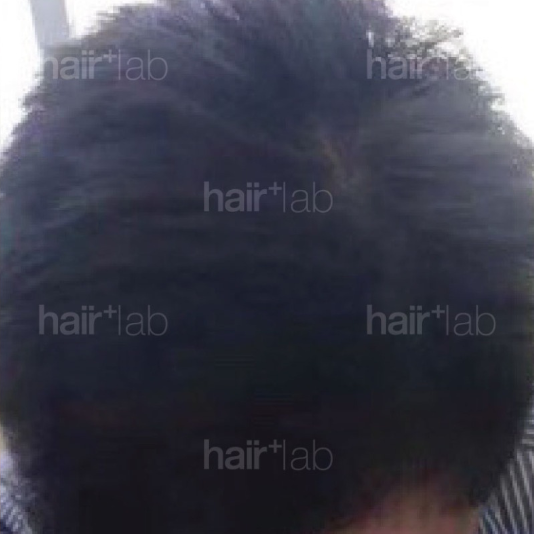 m shape hair loss after