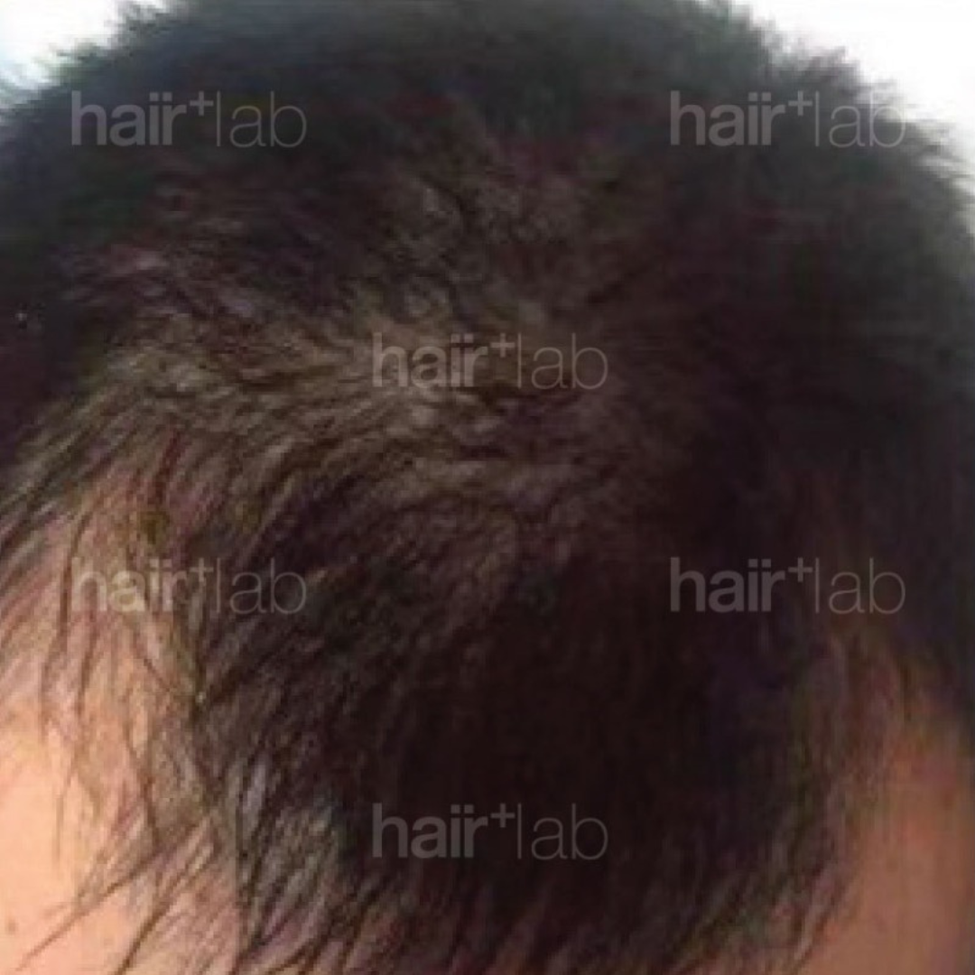 m shape hair loss before