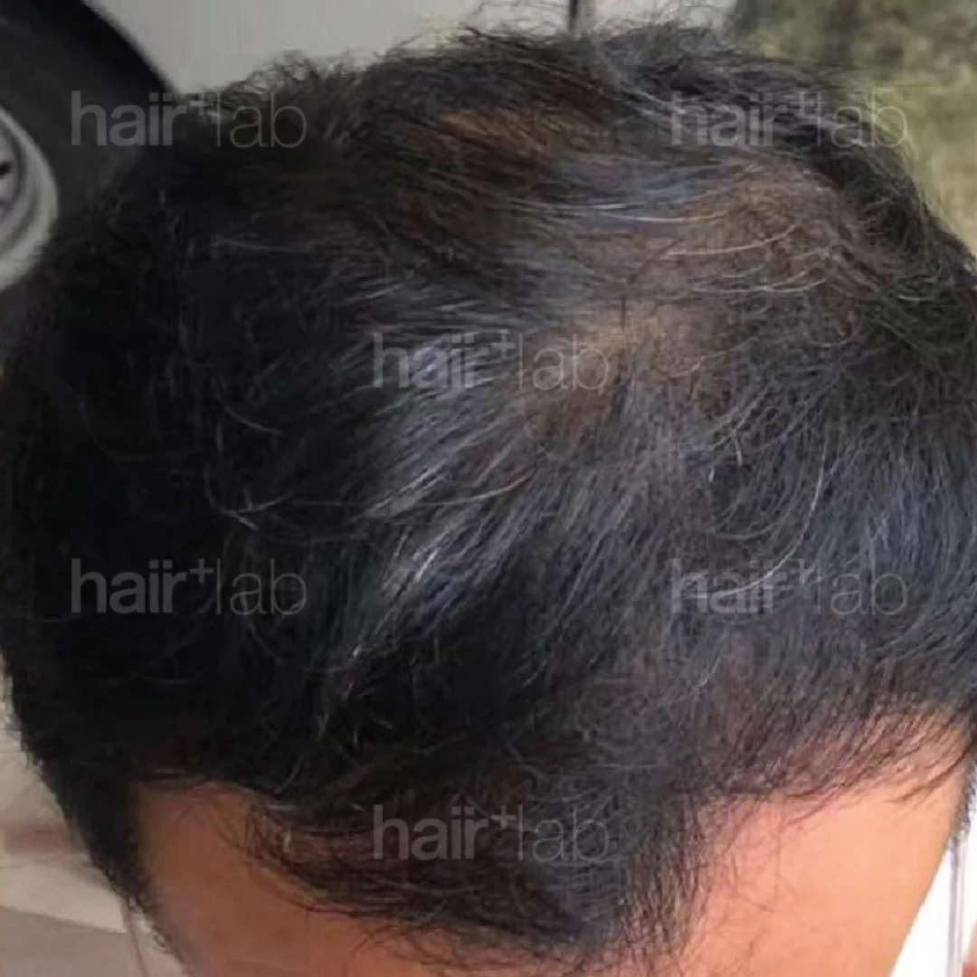 male pattern hair loss after
