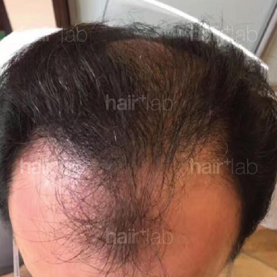 male pattern hair loss before