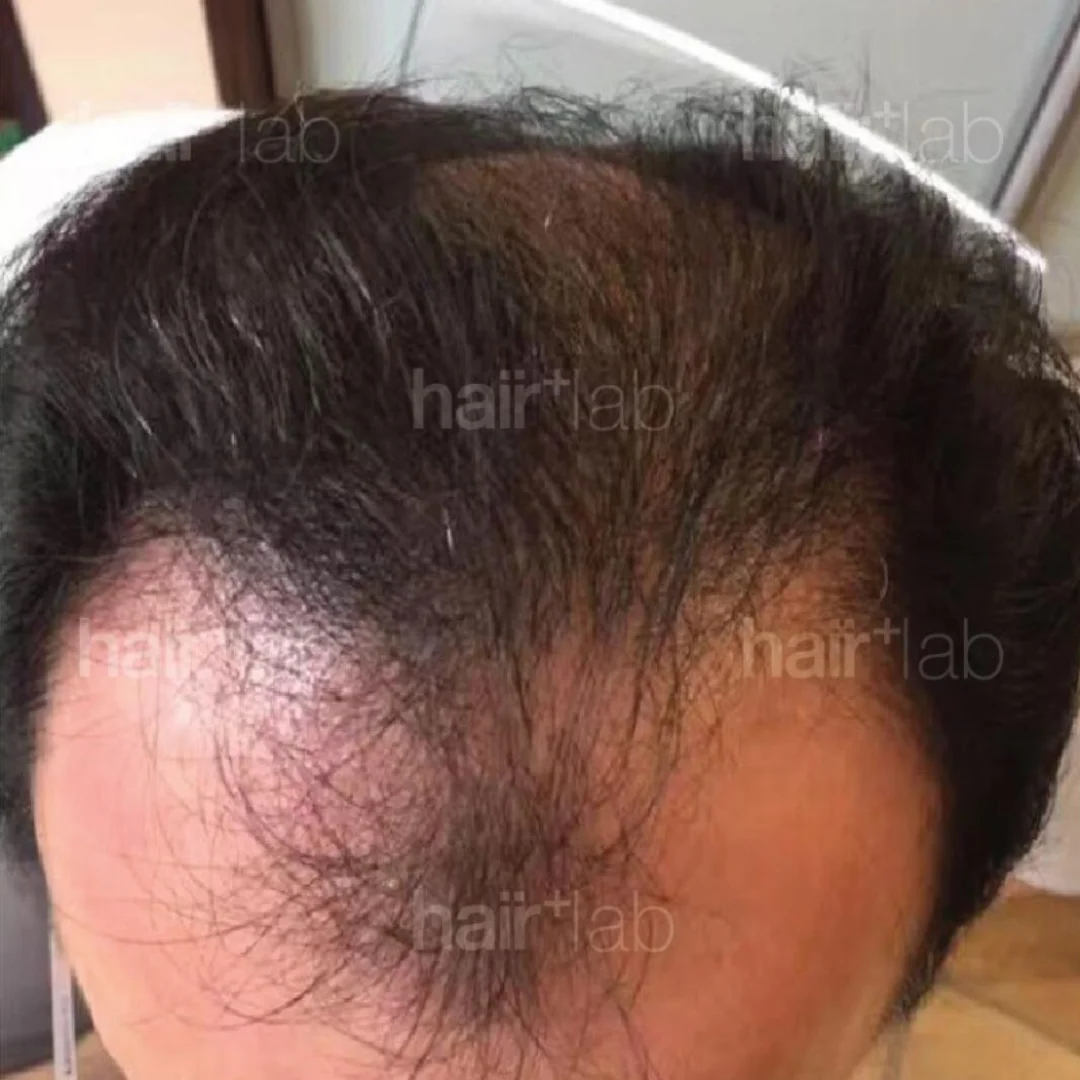 male pattern hair loss before