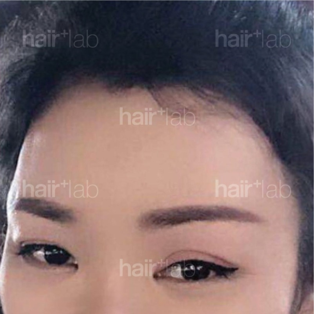 postpartum hair loss after