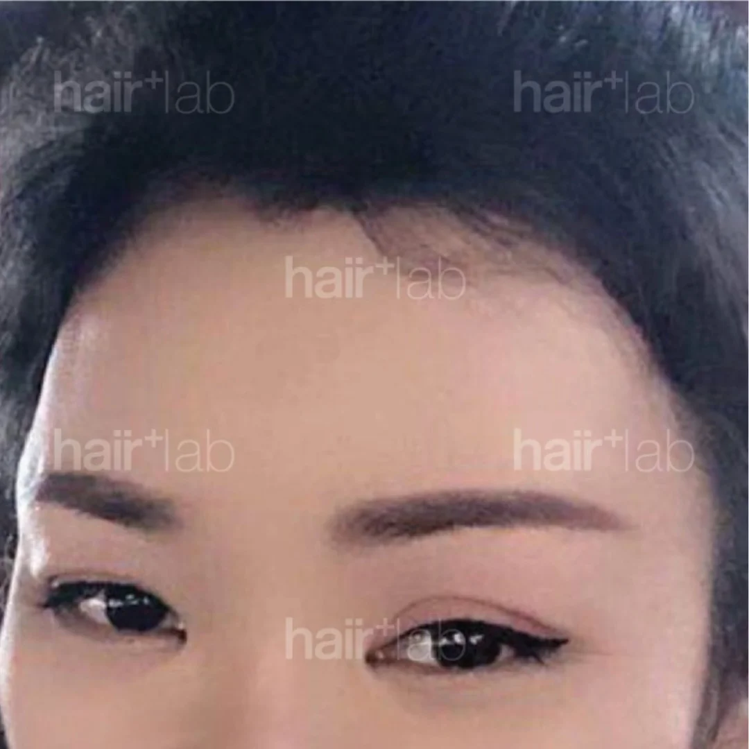 postpartum hair loss after