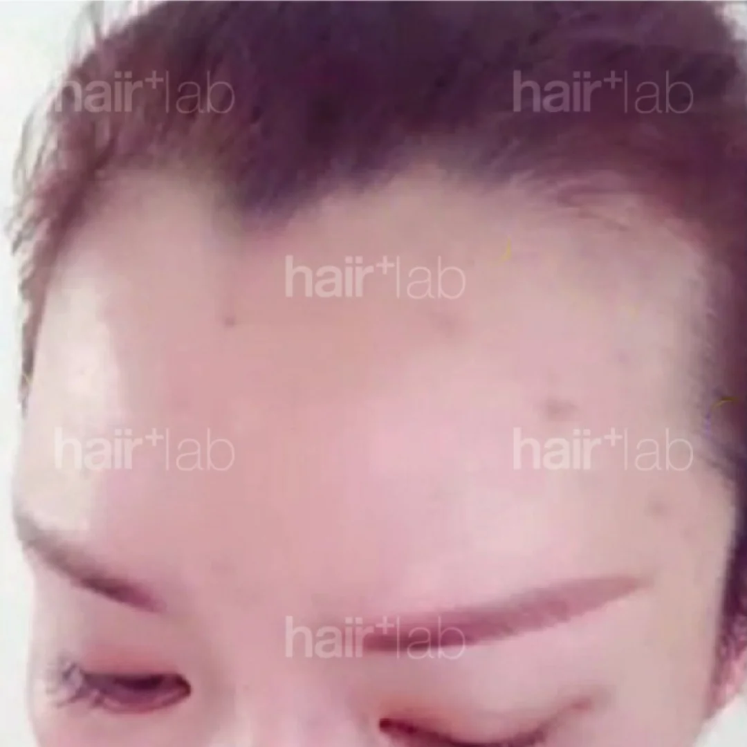 postpartum hair loss before