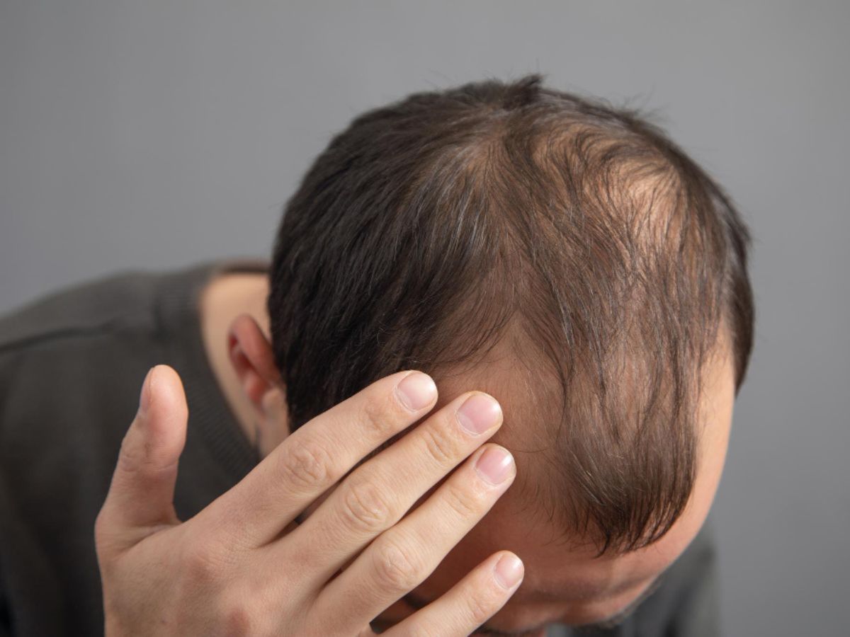 Hair loss treatment