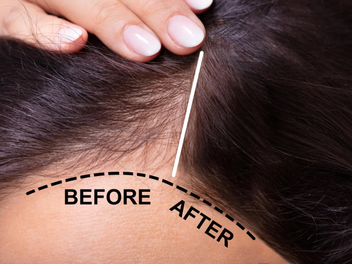 Understanding Hair Growth Singapore: From Hair Loss to Regrowth