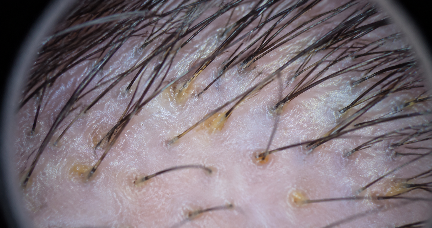 How Scalp Buildup Causes Hair Loss – And What You Can Do About It